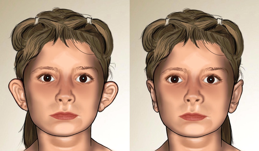 kepce kulak ameliyatlari